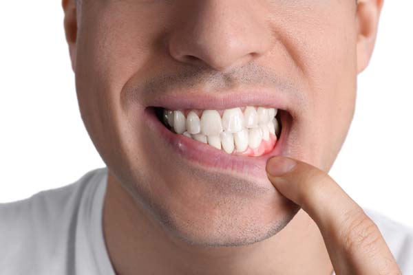 What Happens If Gum Disease Goes Untreated?